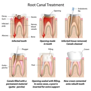 Root Canal Treatment Procedure